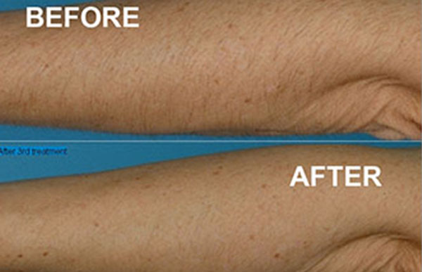 hair removal lower arm