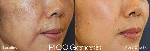 pico genesis face and jaw