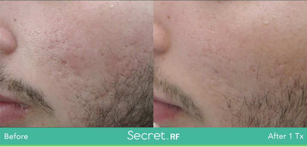Before and After Secret RF Treatment