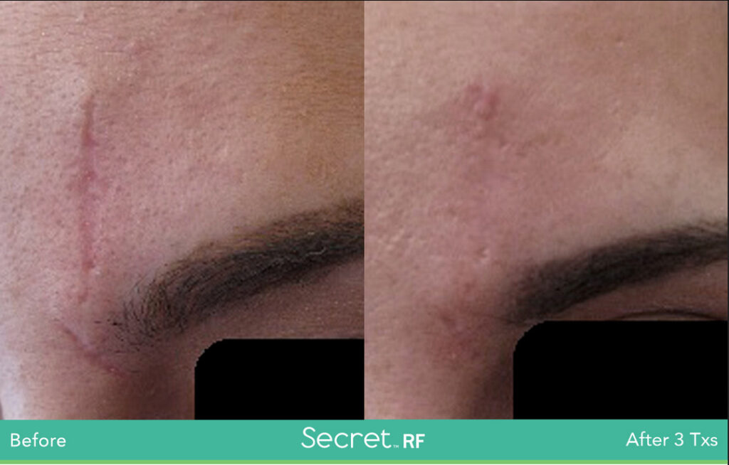 Before and After Secret. RF