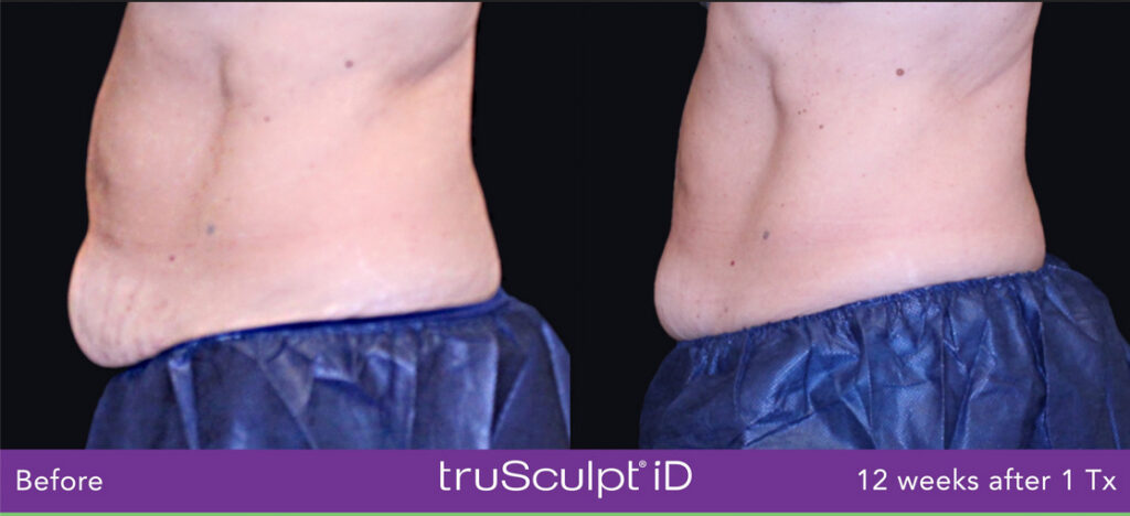 Before/After truSculpt iD