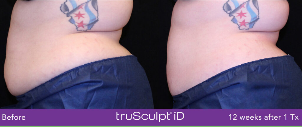 trusculpt on stomach