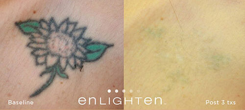 tattoo removal by enlighten