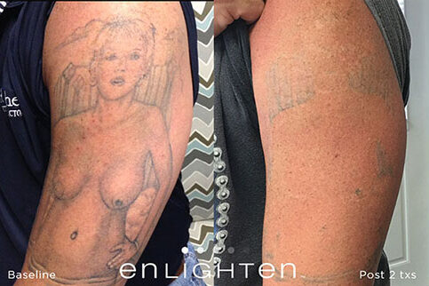 enlighten upper arm tattoo removal