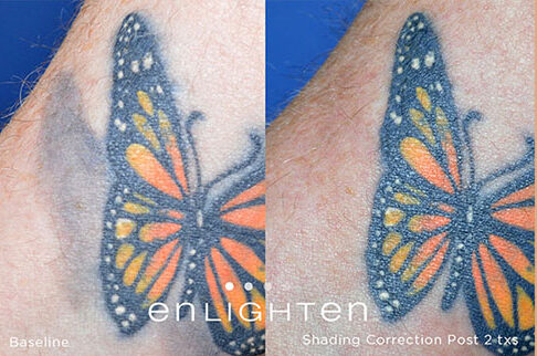tattoo shading correction