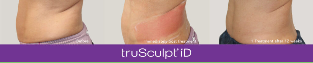 trusculpt iD body contouring treatment before and after
