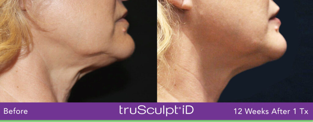 trusculpt iD body sculpting treatment before and after