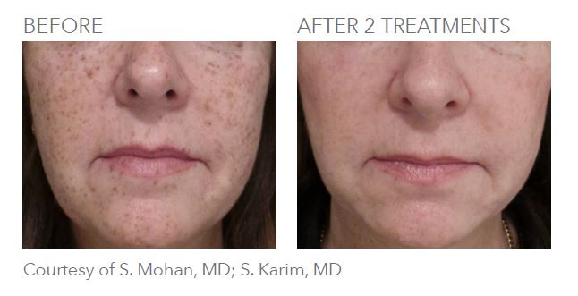 Pico Genesis laser skin revitalization Before and After 1