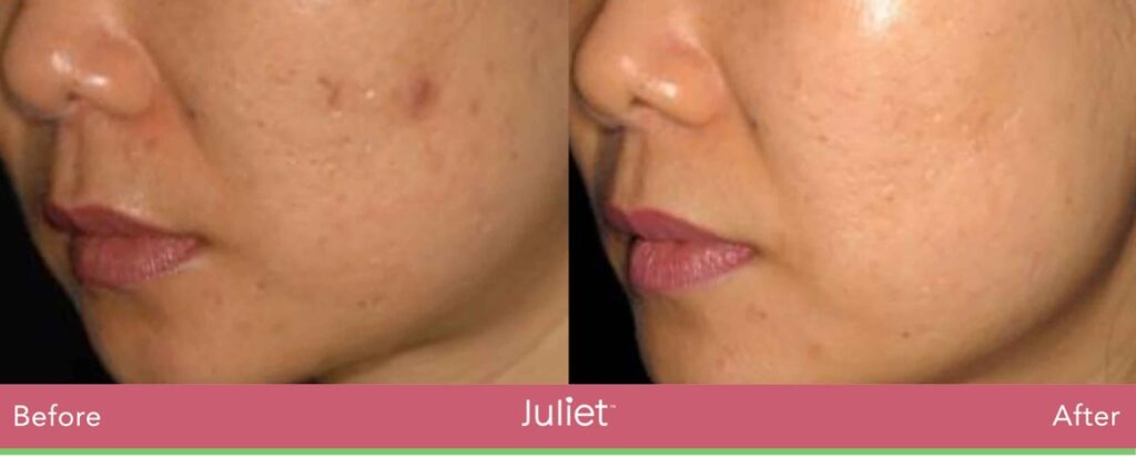 juliet skin treatment