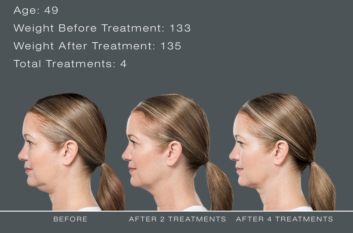 Kybella® Injectable Double Chin Treatment In North Little Rock At ...