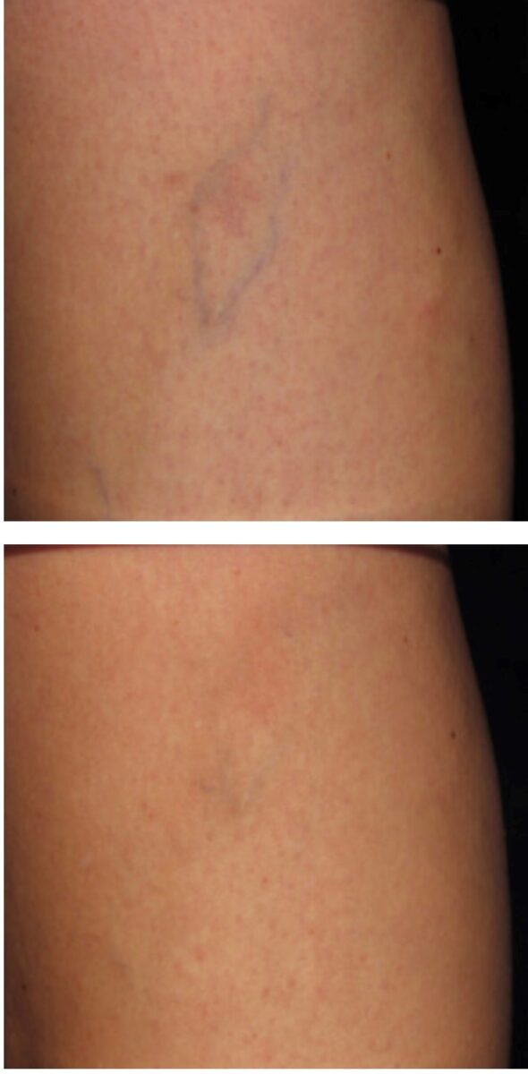 Sclerotherapy Treatment For Varicose And Spider Veins In North Babe