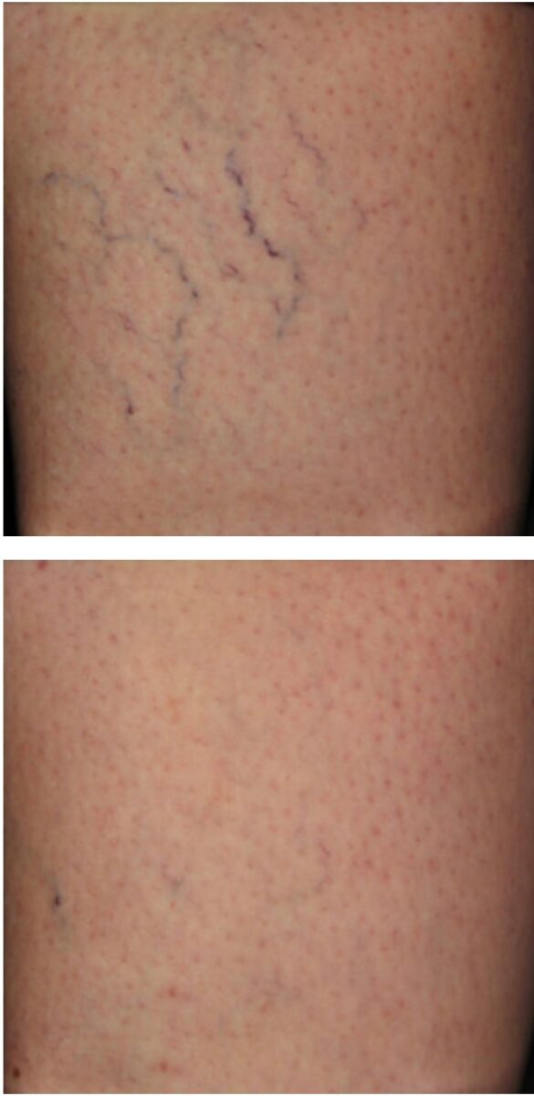 Sclerotherapy Treatment for Varicose and Spider Veins in North